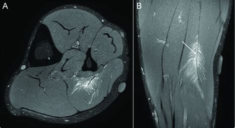 what test shows muscle tears|mri for muscle tear.